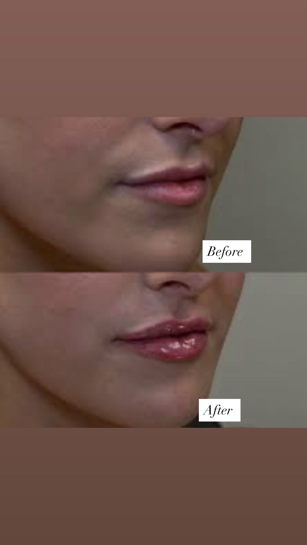 Needle free lip filler