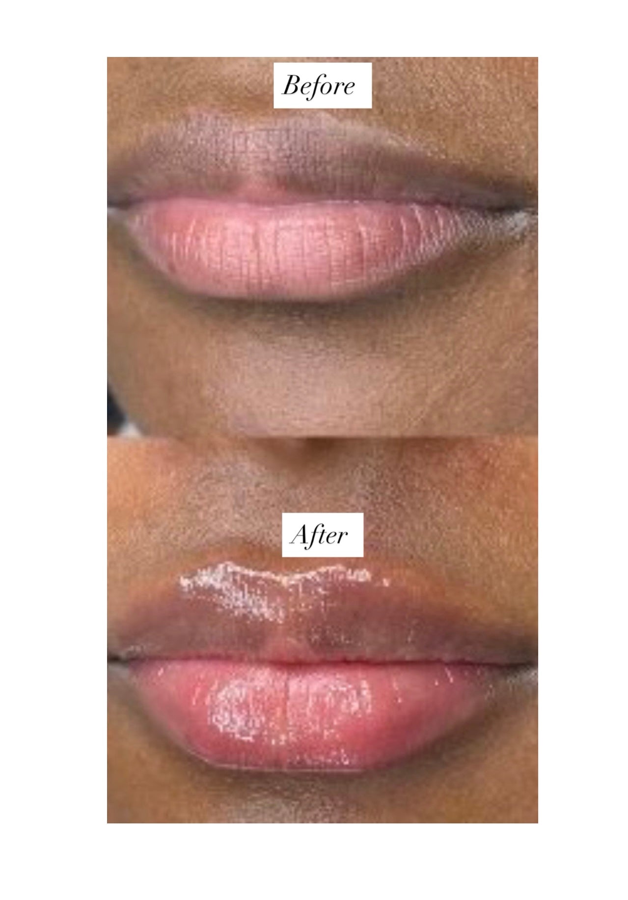 Needle free lip filler